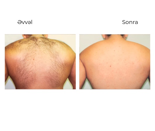 Candela GentleLase Pro-U